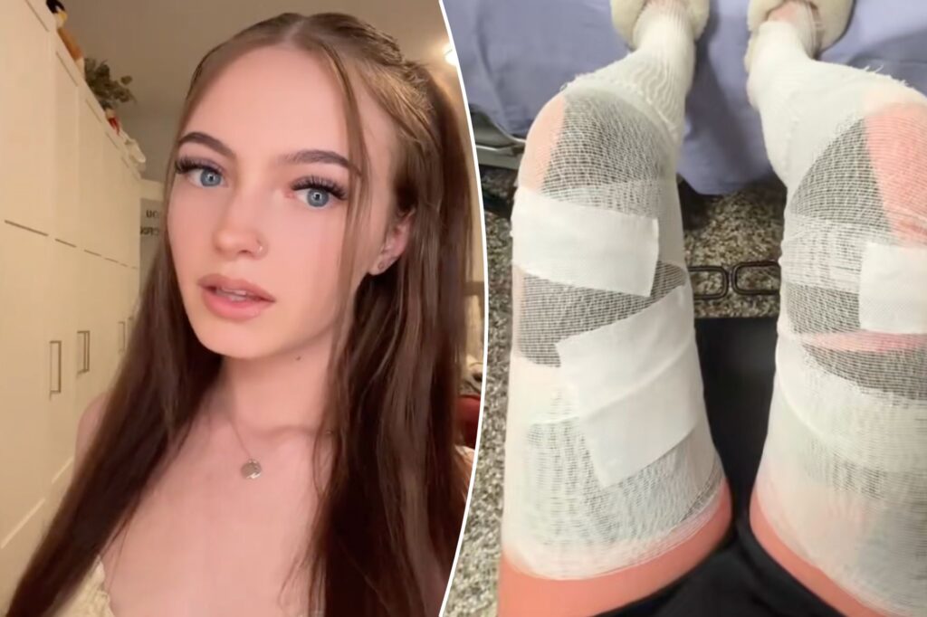The woman left with third grade burns and unable to walk for a week reveals her main mistake: "I will never forget this"